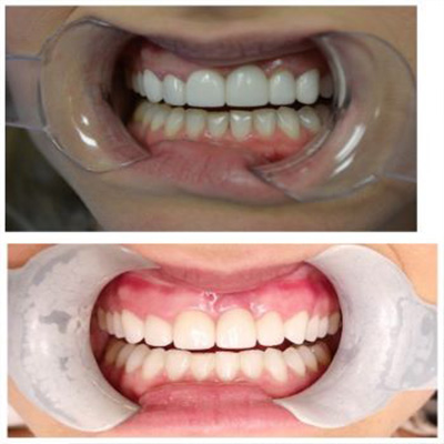 Granger Dentistry | Implant Restorations, Oral Cancer Screening and Invisalign reg 