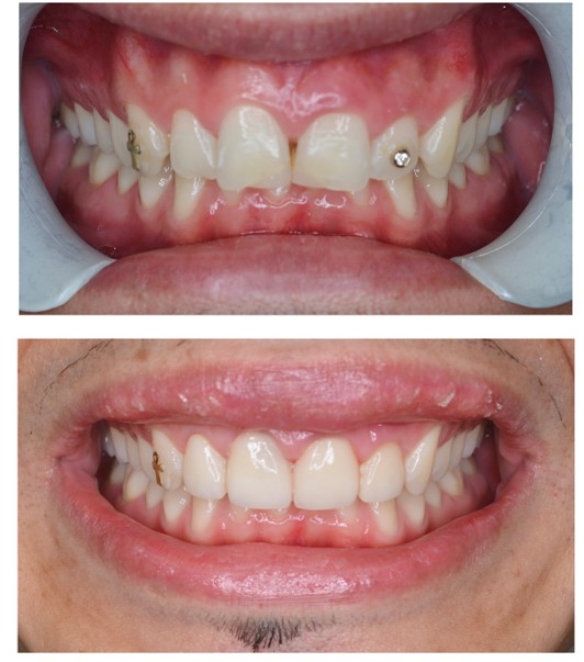 Granger Dentistry | ZOOM  Whitening, Oral Cancer Screening and Dentures