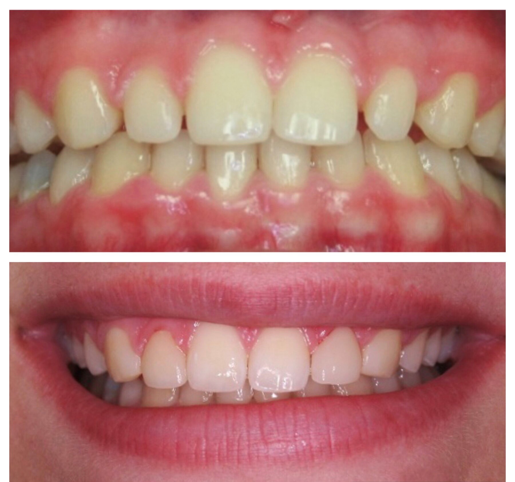 My Gilroy Dentist | Crowns  amp  Caps, Extractions and Dental Fillings