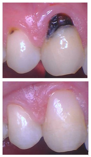 My Gilroy Dentist | Extractions, Crowns  amp  Caps and Dentures