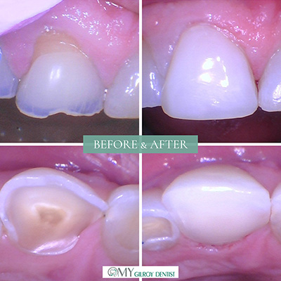  My Gilroy Dentist | Botulinum Toxin, Dental Cleanings and Invisalign reg 