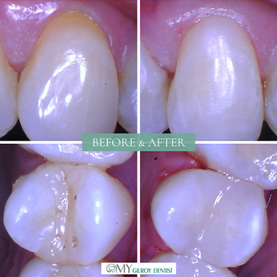  My Gilroy Dentist | Dentures, Teeth Whitening and Pediatric Dentistry