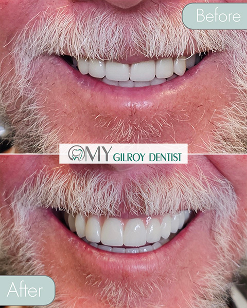  My Gilroy Dentist | Dentures, Teeth Whitening and Pediatric Dentistry