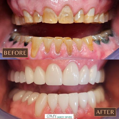  My Gilroy Dentist | Dentures, Teeth Whitening and Pediatric Dentistry