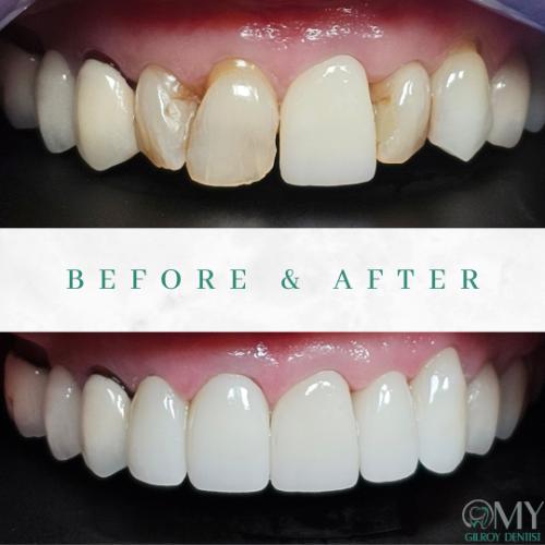  My Gilroy Dentist | Dental Cleanings, Periodontal Treatment and Dental Bridges