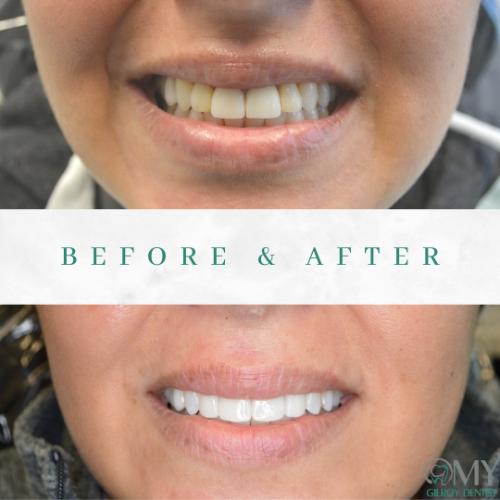  My Gilroy Dentist | Night Guards, Dental Bridges and Implant Dentistry