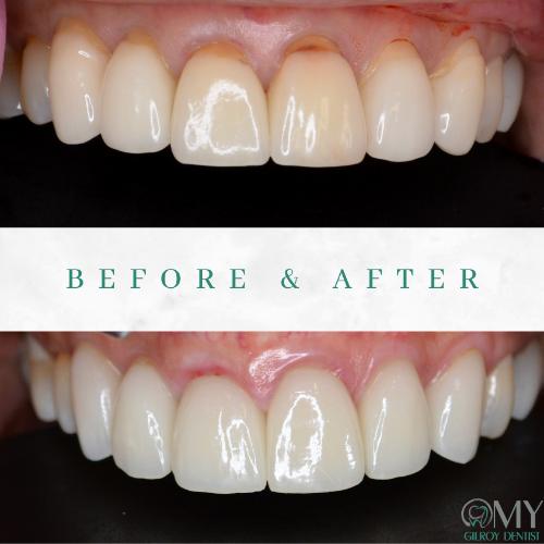  My Gilroy Dentist | Botulinum Toxin, Dental Cleanings and Invisalign reg 