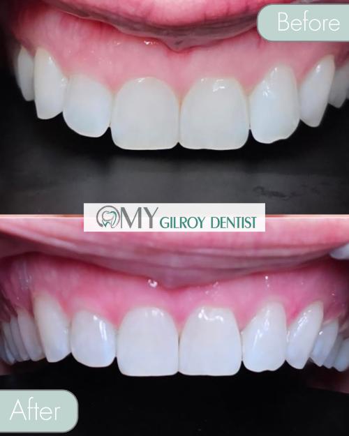  My Gilroy Dentist | Botulinum Toxin, Dental Cleanings and Invisalign reg 