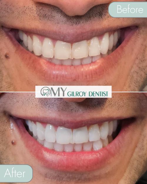  My Gilroy Dentist | Dentures, Teeth Whitening and Pediatric Dentistry