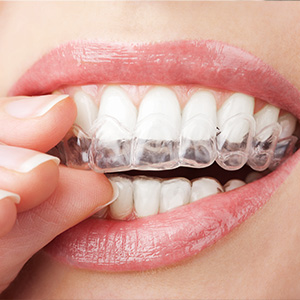 Granger Dentistry | ZOOM  Whitening, Veneers and Orthodontics